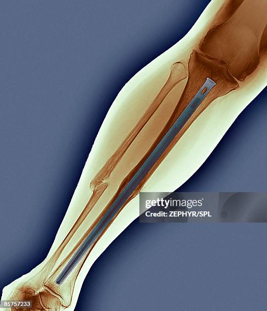 pinned broken leg - surgical pin stock pictures, royalty-free photos & images