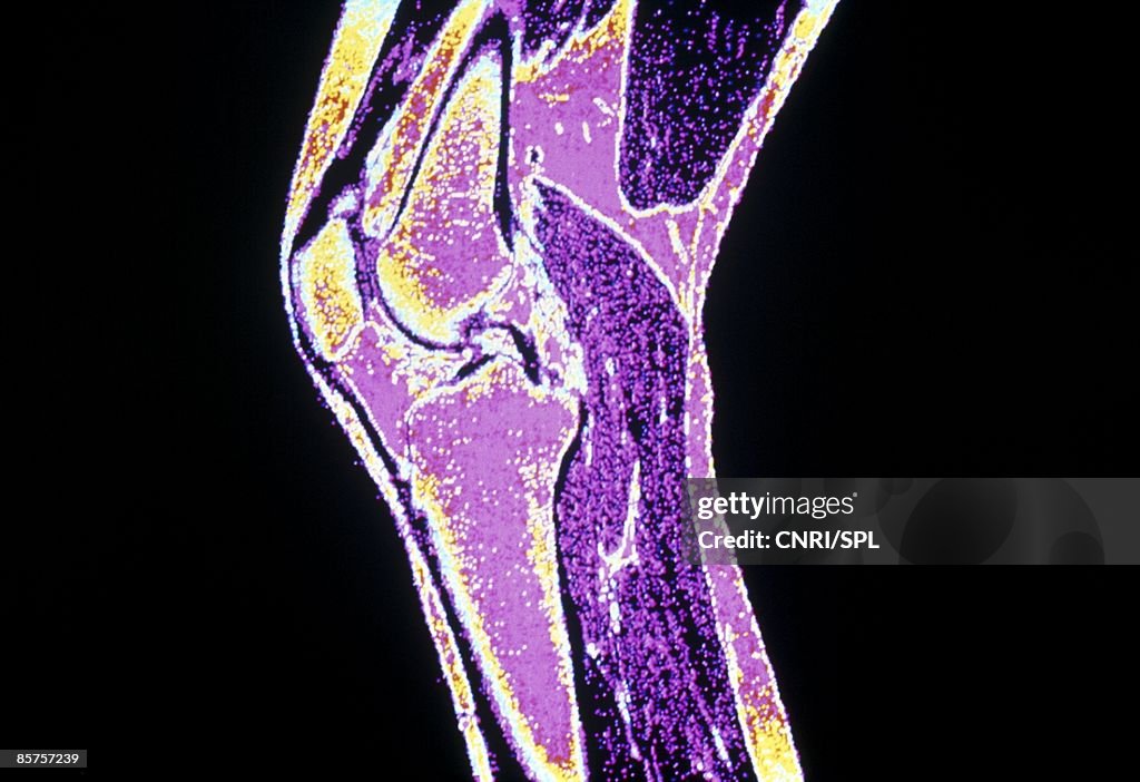 Magnetic Resonance Image (MRI) of Human knee