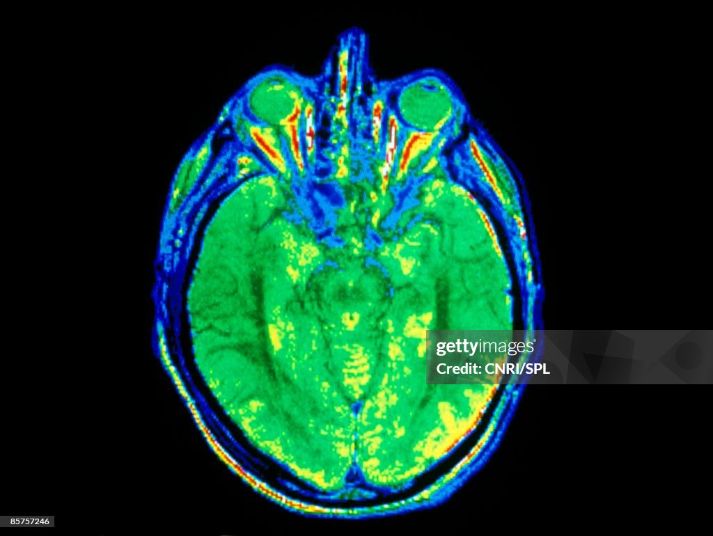MRI scan of brain