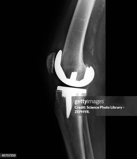 prosthetic knee joint, (b&w) - knee replacement surgery - fotografias e filmes do acervo