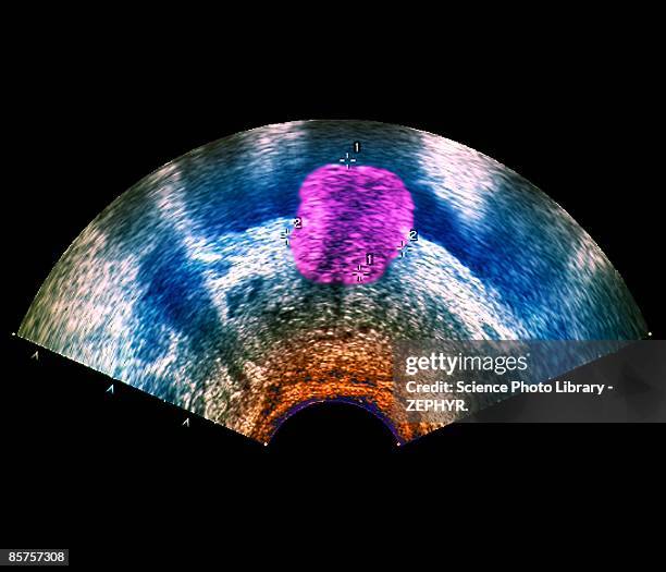 prostate tumor - hyperplasia stock pictures, royalty-free photos & images