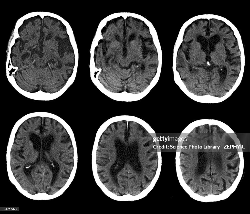 CAT scan of brain, Alzheimer's disease (B&W)