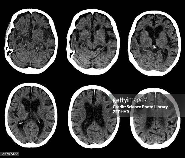 cat scan of brain, alzheimer's disease (b&w) - skull xray no brain stock pictures, royalty-free photos & images