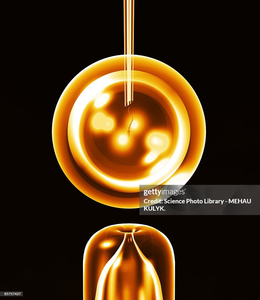 In vitro fertilization (IVF)