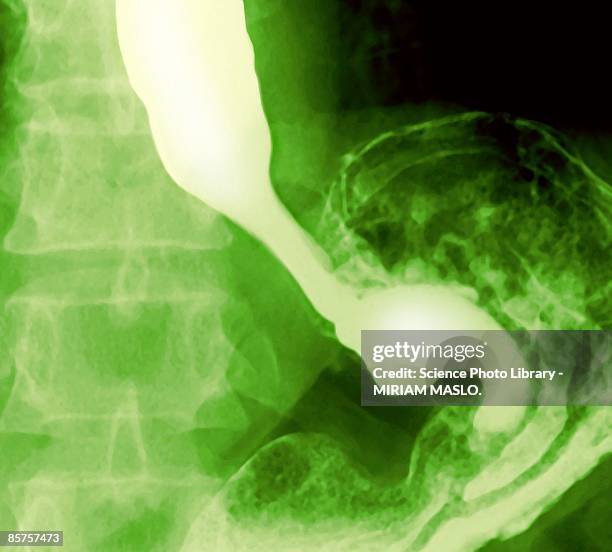 x-ray of normal esophagus and stomach - esophagus stock pictures, royalty-free photos & images