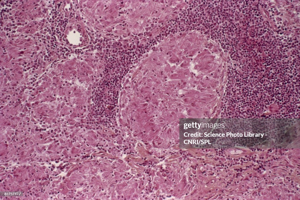 Tuberculosis