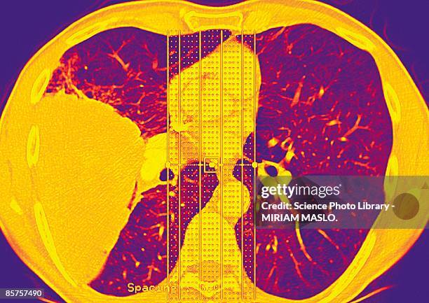 lung cancer - membrane fotografías e imágenes de stock