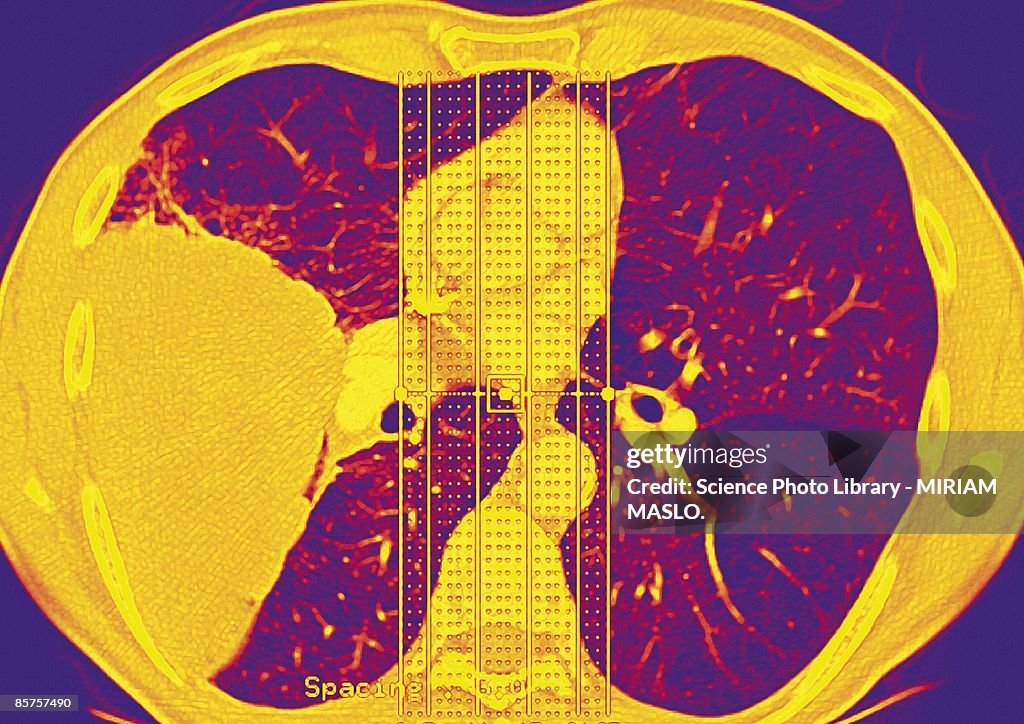 Lung cancer