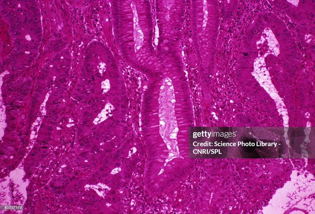 Colon cancer, close-up