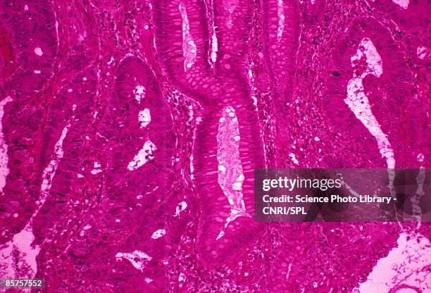 colon cancer, close-up - sigmoid colon stock pictures, royalty-free photos & images