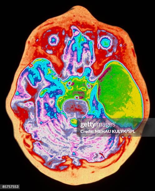 Mri Example Axial Axial Photos and Premium High Res Pictures - Getty Images
