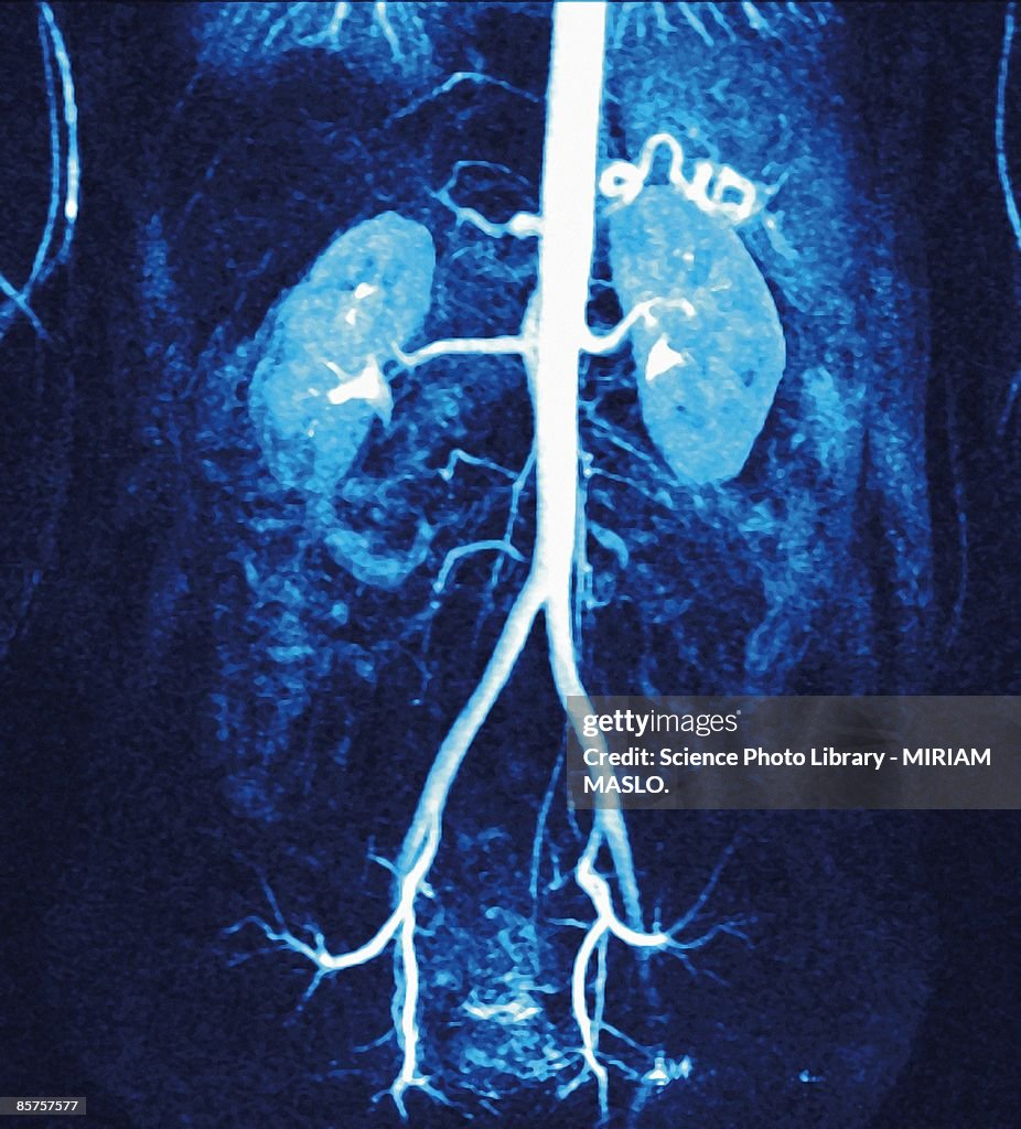 Renal Arteries