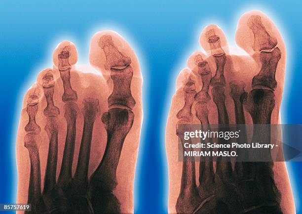 Amputating 79 Toe Amputation Stock Photos, High-Res Pictures, and Images - Getty ...