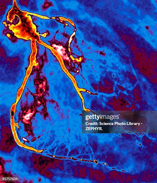 narrowed coronary arteries - atherosclerosis stock pictures, royalty-free photos & images