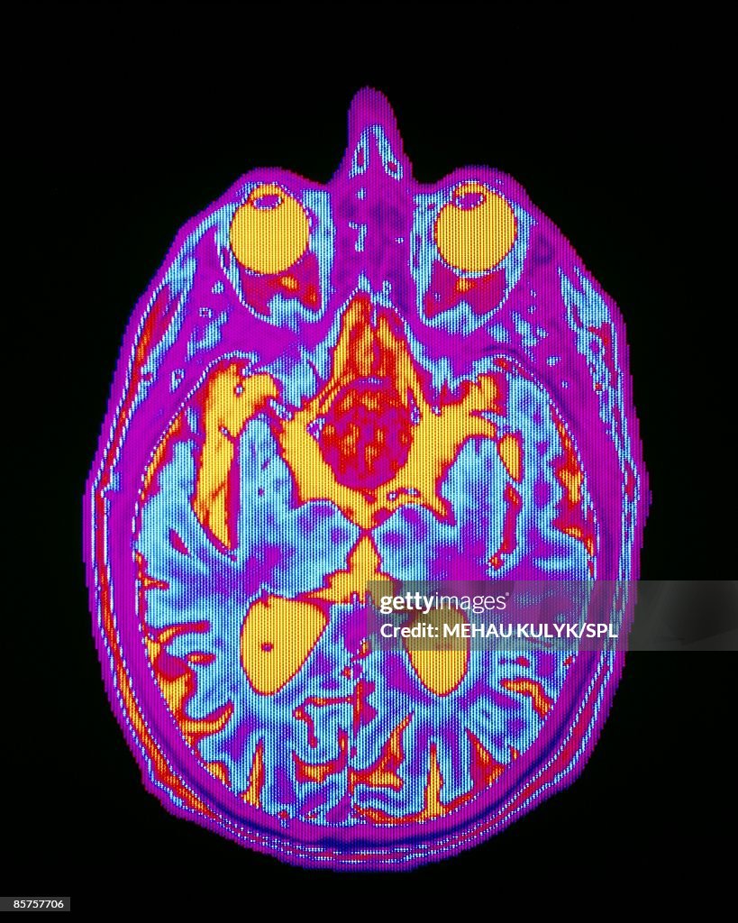 Pituitary tumor, close-up