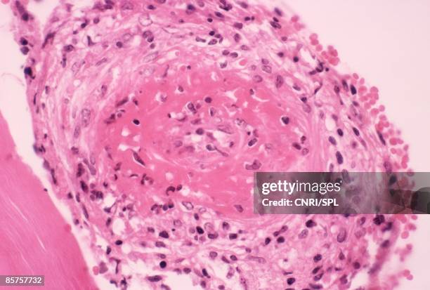 light micrograph of section through human artery - thrombolytic stock pictures, royalty-free photos & images