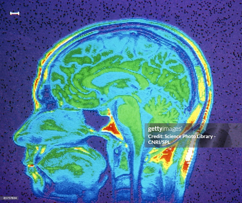 MRI scan of brain, close-up