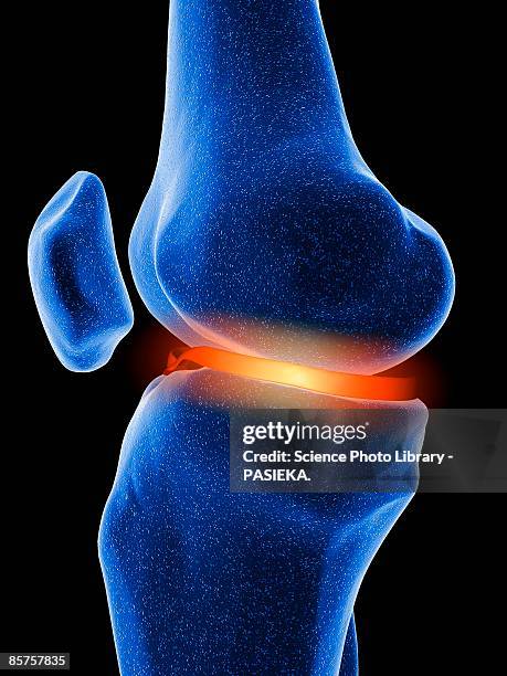 ilustrações, clipart, desenhos animados e ícones de inflamed knee cartilage against black background - fêmur