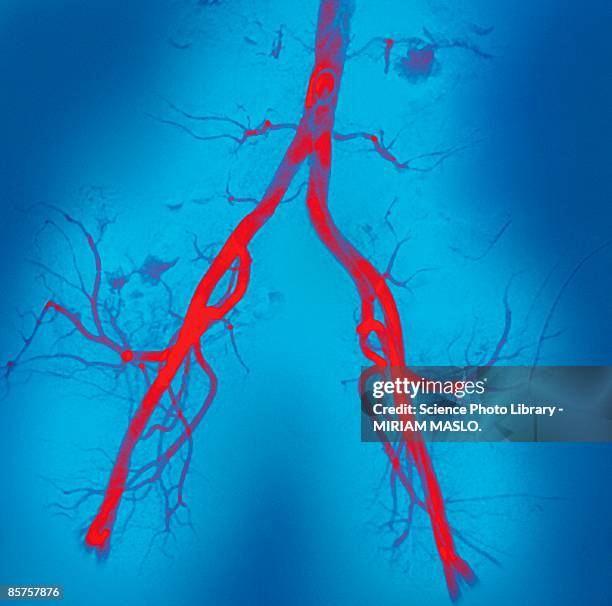 narrowed abdominal arteries, colored angiogram - vaso sanguigno foto e immagini stock