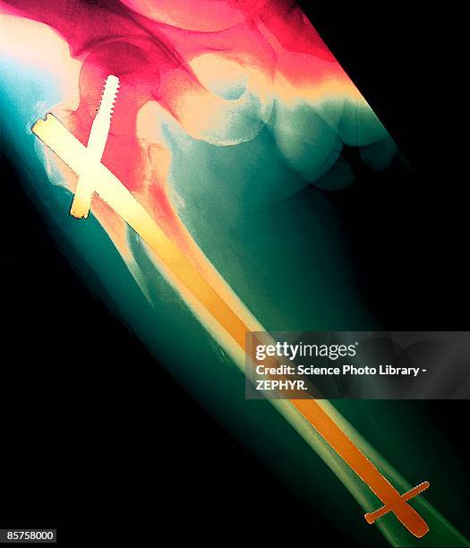 pinned broken leg colored x-ray, close-up - surgical pin stock pictures, royalty-free photos & images