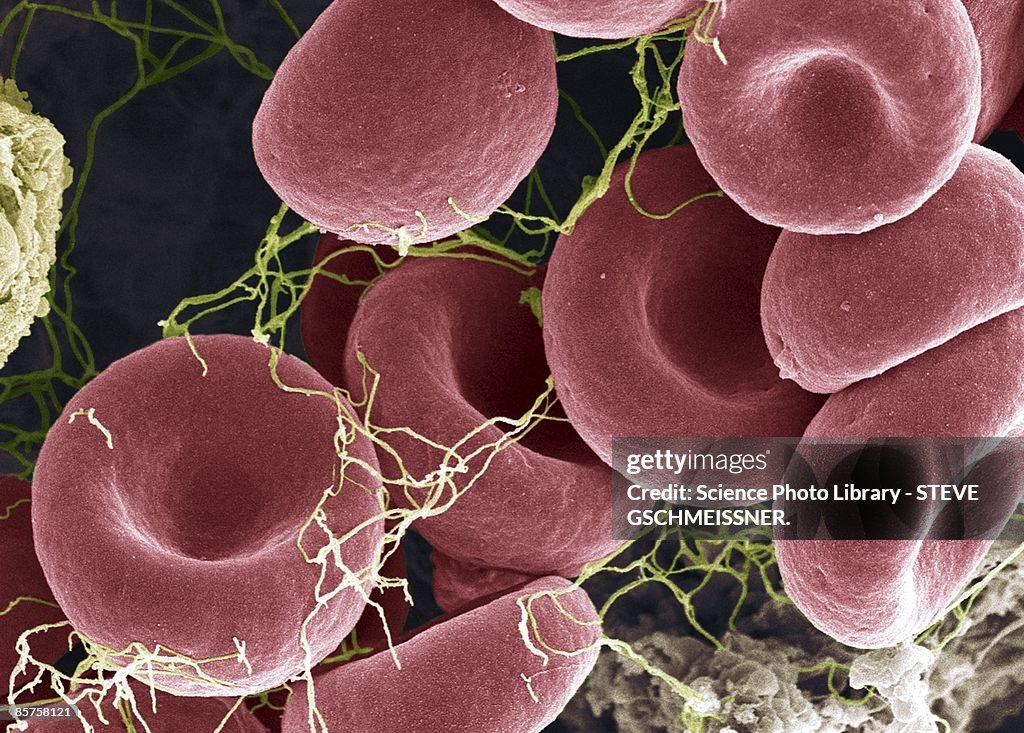 Blood clot, colored scanning electron micrograph (SEM)