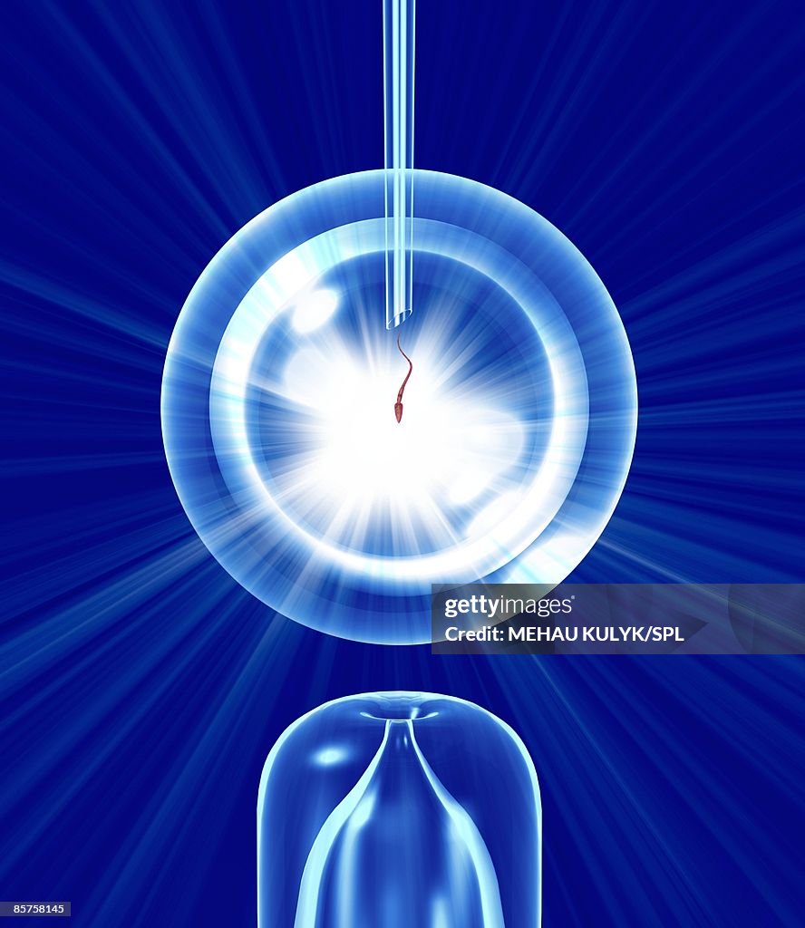 In vitro fertilization (IVF)