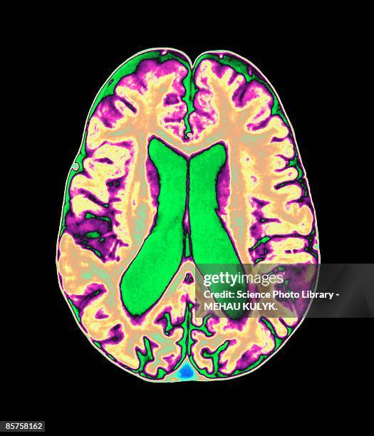 organophosphate brain damage - cerebral cortex fotografías e imágenes de stock