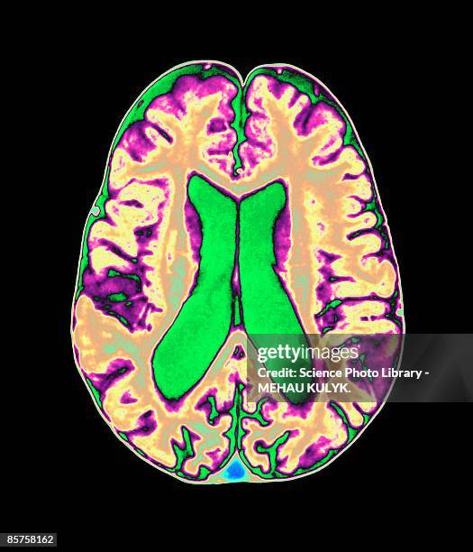 organophosphate brain damage - brain damage stock pictures, royalty-free photos & images