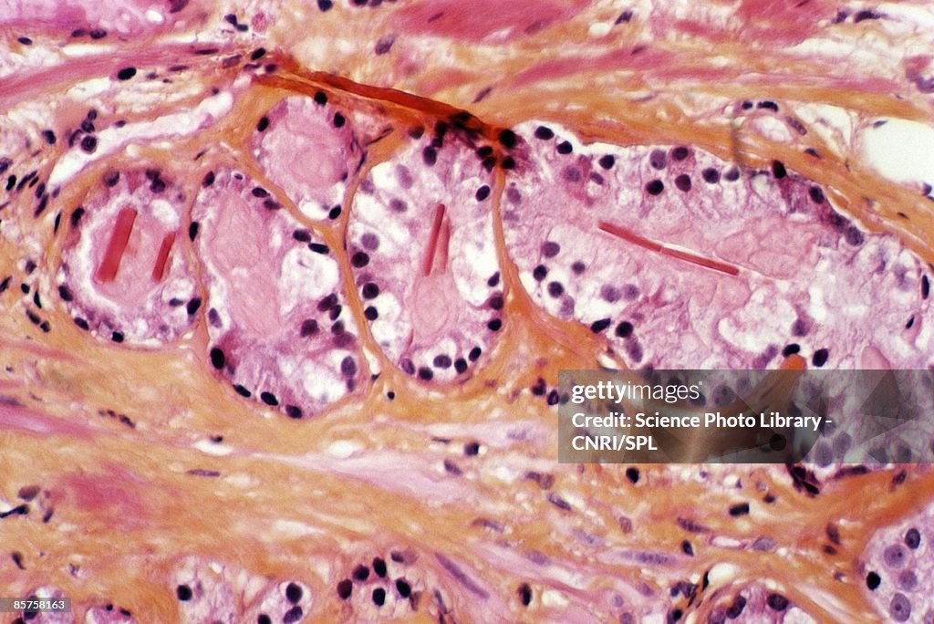 Prostate cancer