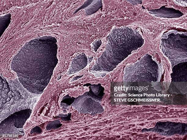 prostate cancer, scanning electron microscope (sem) - micrografia elettronica a scansione foto e immagini stock