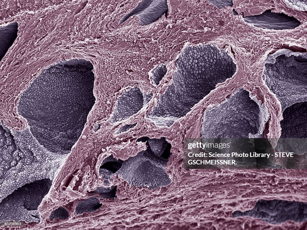 Prostate cancer, scanning electron microscope (SEM)
