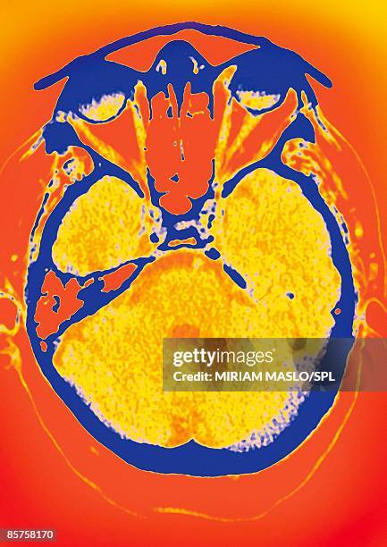 normal brain, colored axial computed tomography scan - skull xray no brain stock pictures, royalty-free photos & images