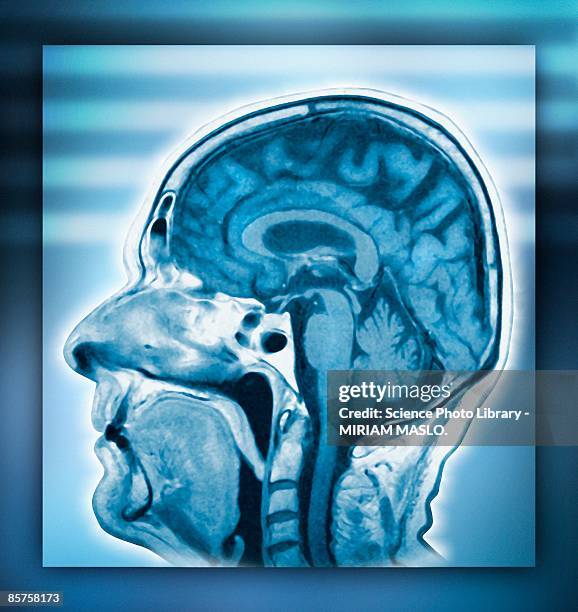 Bone Brain Scan 1,543 Nuclear Medicine Bone Scan Stock Photos, High-Res Pictures, and ...