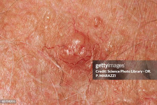 skin cancer, close-up - basalcellscancer bildbanksfoton och bilder
