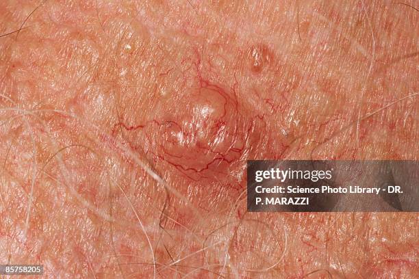 skin cancer, close-up - basal cell carcinoma 個照片及圖片檔