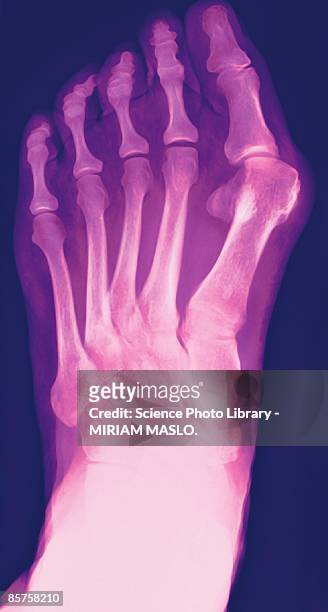 x-ray of human foot, close-up - hallux valgus foto e immagini stock