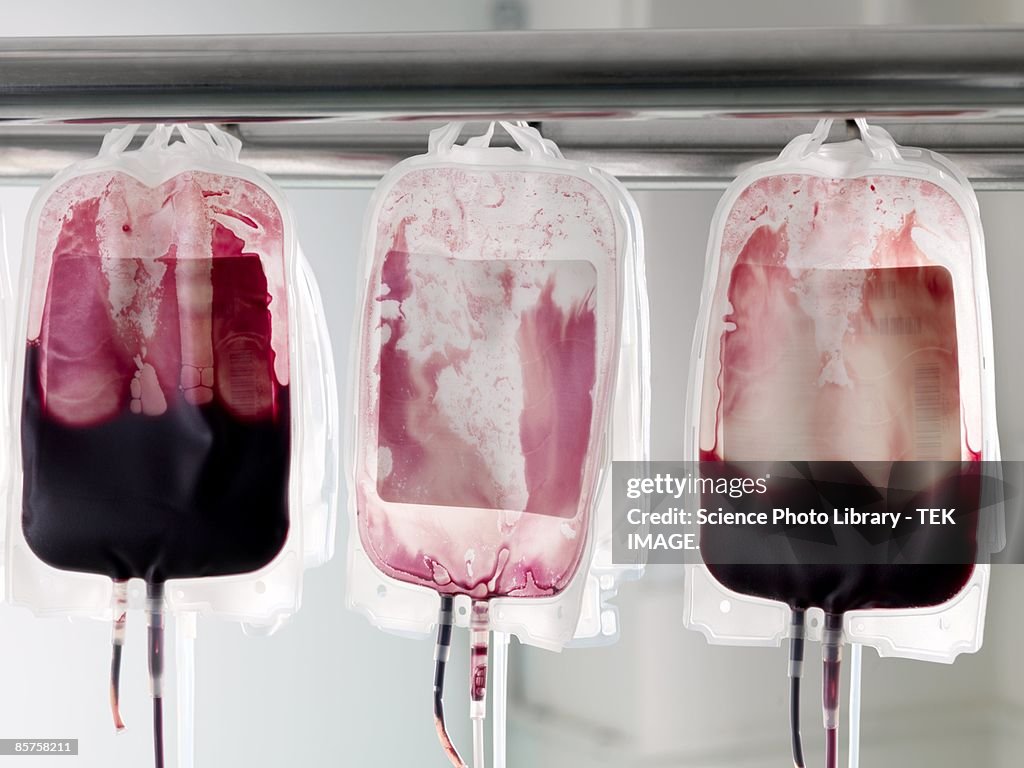 Donor blood in blood bags being separated into its component parts