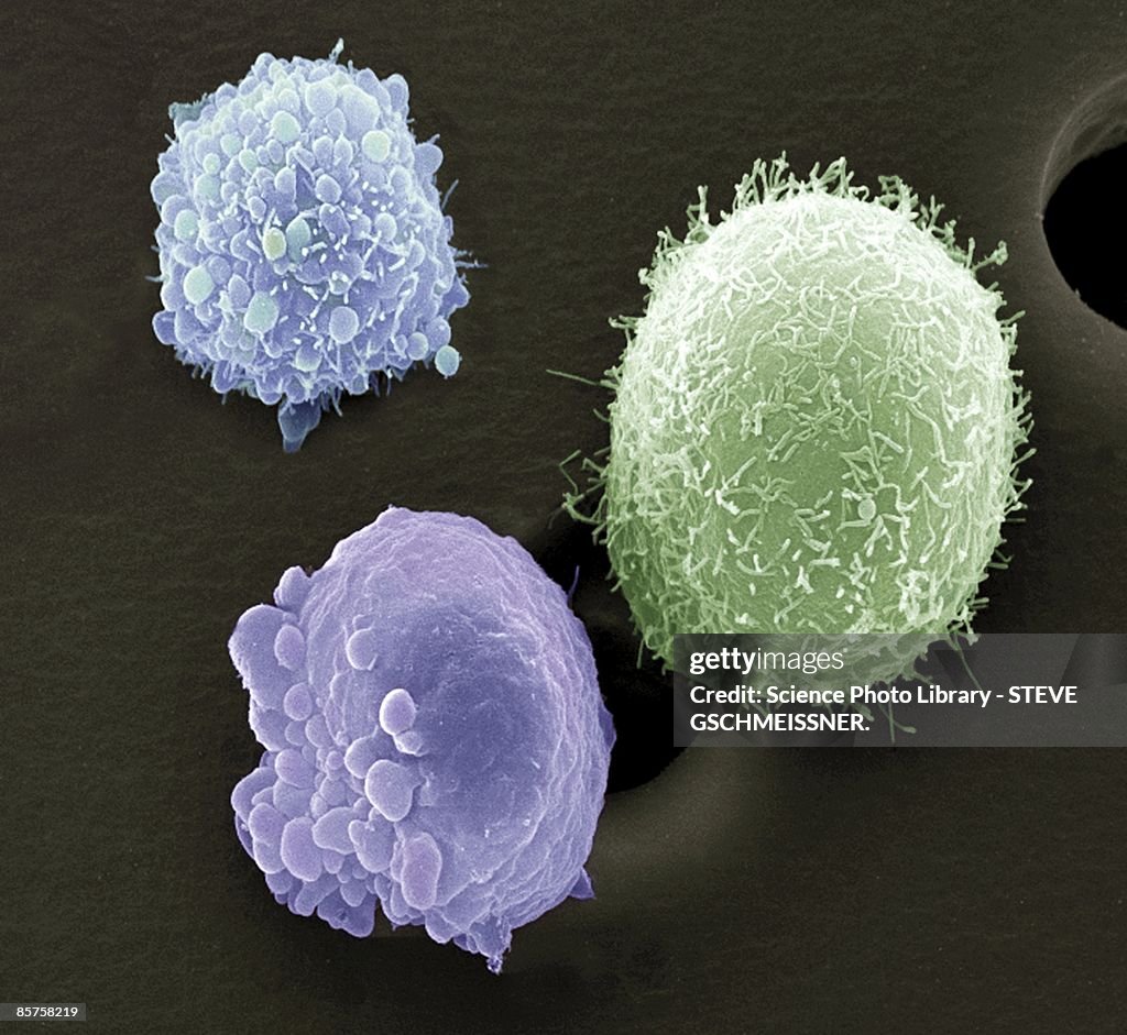 Skin cancer cells, scanning electron microscope (SEM)