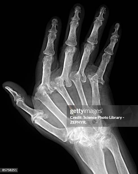 x-ray of hand of patient - arthritis hand 3d stock pictures, royalty-free photos & images