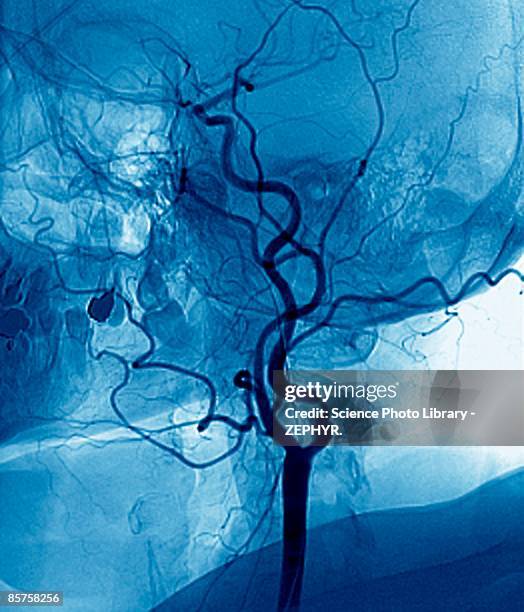 narrowed neck artery - human artery foto e immagini stock