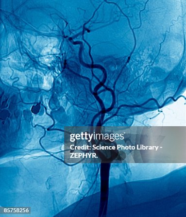 Narrowed neck artery Narrowed neck artery