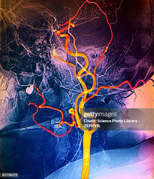 narrowed neck artery - artère humaine photos et images de collection