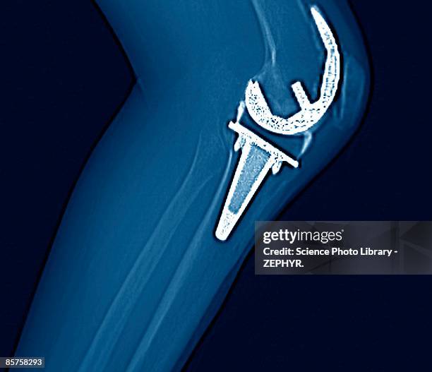 scan of artificial knee joint - knee replacement stock pictures, royalty-free photos & images