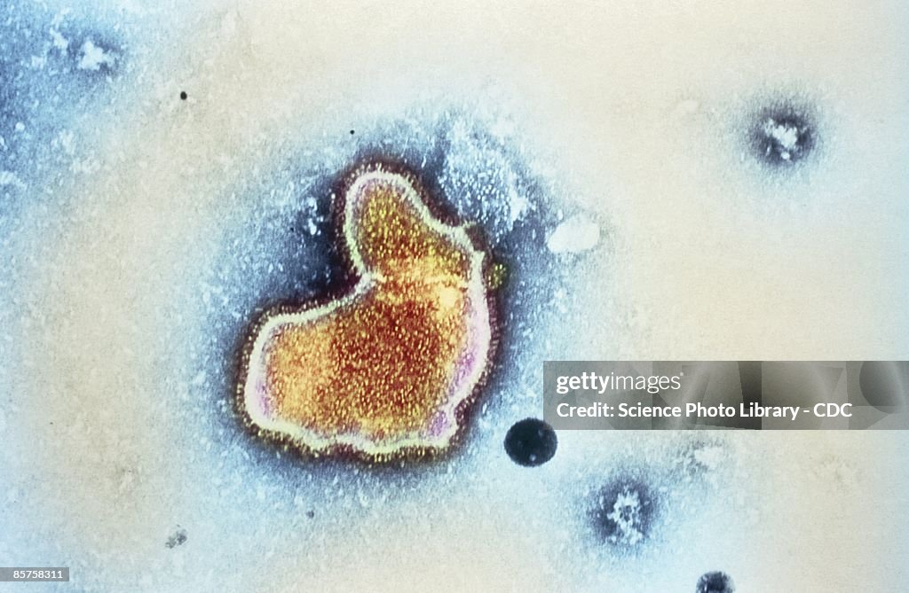 Pneumonia, transmission electron micrograph (TEM)