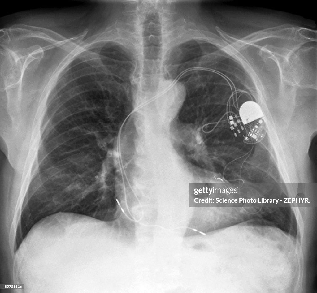 Heart pacemaker x-ray of senior adult man, (B&W)