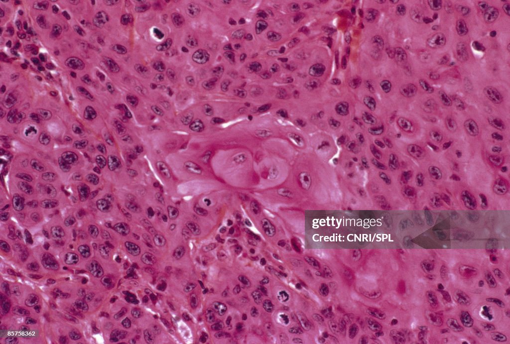 Skin cancer, close-up