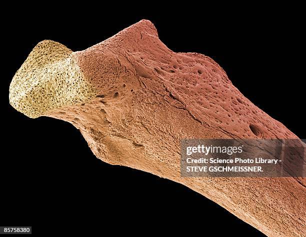 scanning electron micrograph (sem) of human bone, osteoporosis - scientific micrograph stock-fotos und bilder