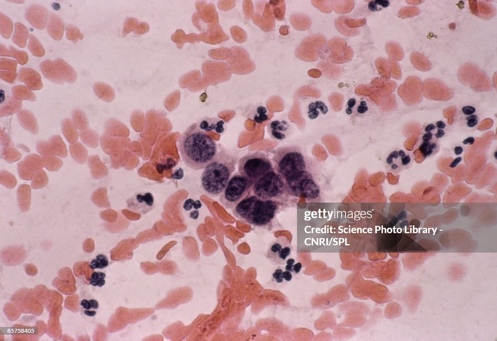 Vaginal cancer