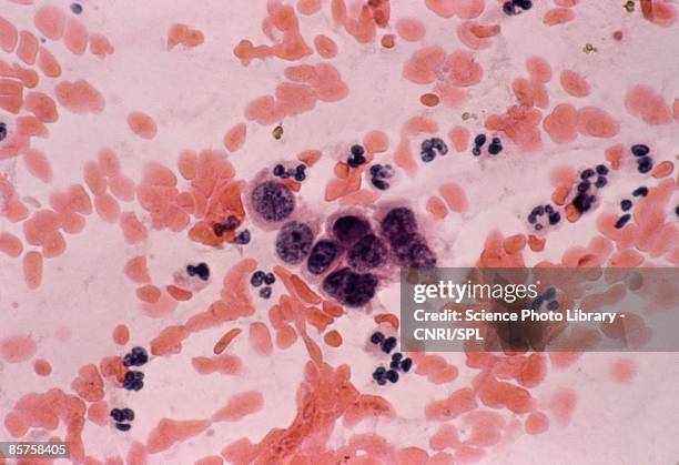 vaginal cancer - stain test stock pictures, royalty-free photos & images