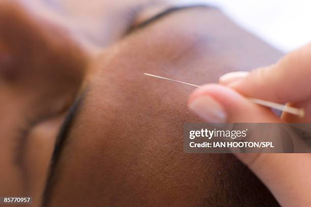 Acupuncture High-Res Stock Photo